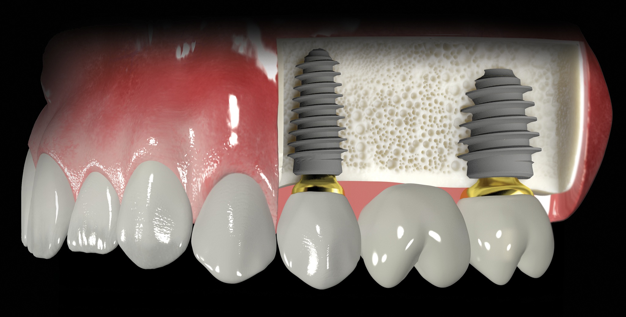 Implantes dentales.